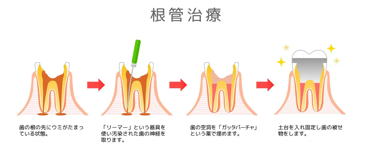 根管治療は「保険」と「自費」どっち？治療の違い