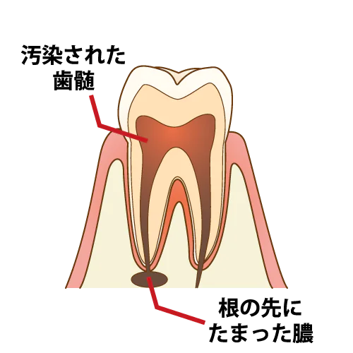 歯茎が腫れる・痛い…この症状は膿が溜まっているから？
