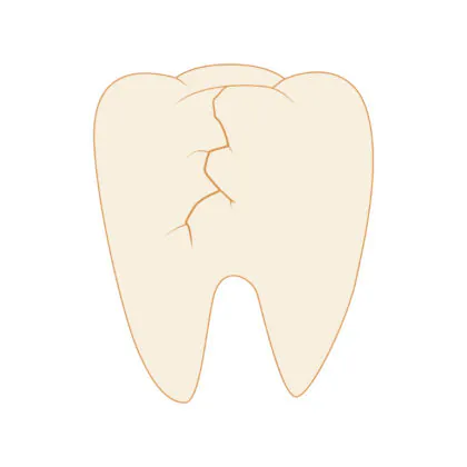 歯にヒビが入るとどうなる？