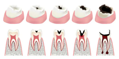 ひどい虫歯とはどんな状態？症状は？