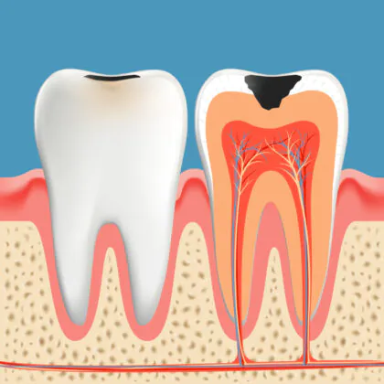 「歯の神経の壊死」を放置するリスク