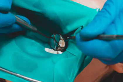 歯の根の感染を除去する「感染根管治療」