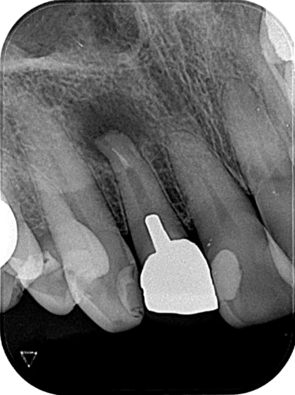 Case02_慢性根尖性歯周炎before