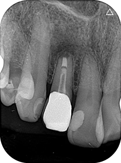 Case01_慢性根尖性歯周炎after