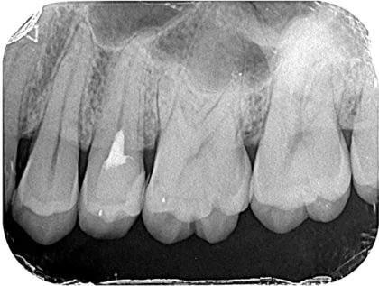 Case02う蝕 歯髄充血_after