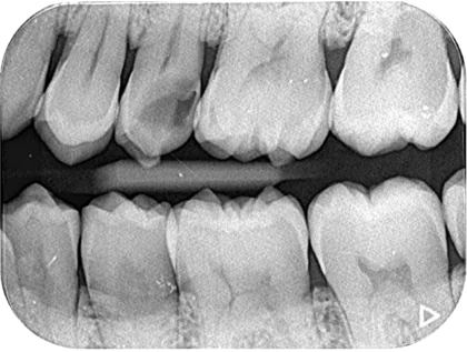 Case02う蝕 歯髄充血_before