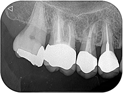 Case03_15 慢性根尖性歯周炎_after