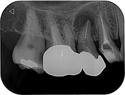 Case0315 慢性根尖性歯周炎_before